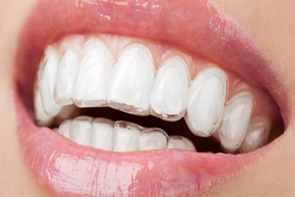 隐形牙箍的原理 隐形牙套的优点