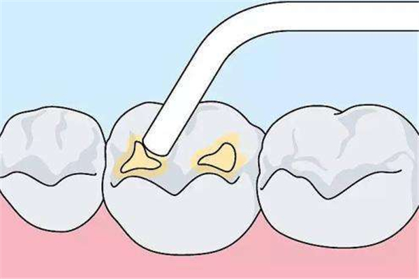 补牙后牙齿疼痛什么原因 补牙后牙齿疼痛怎么办