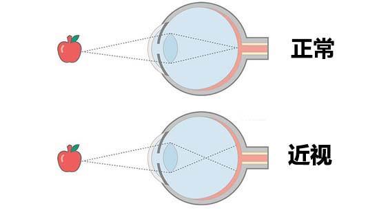 多数人近视的真相，你有多接近视力警戒线？