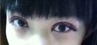 韩式三点双眼皮是永久吗？三点双眼皮能保持多久？