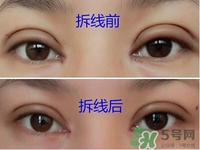 定点双眼皮恢复过程图_定点双眼皮要多久恢复