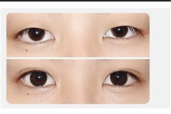 做双眼皮能保持多久 双眼皮做的可以维持多久