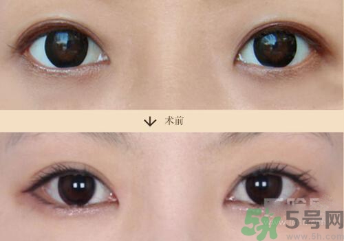 韩式双眼皮价格 韩式双眼皮效果怎么样？