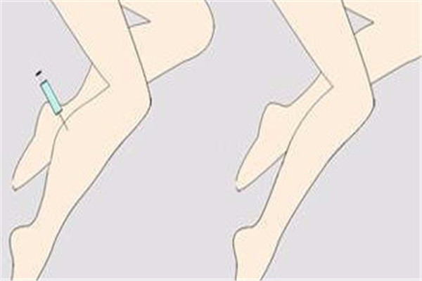 瘦腿针后遗症是什么 瘦腿针安全性
