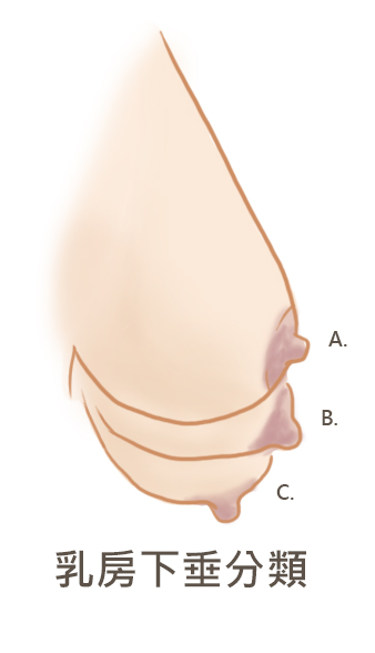 乳房下垂分類.jpg
