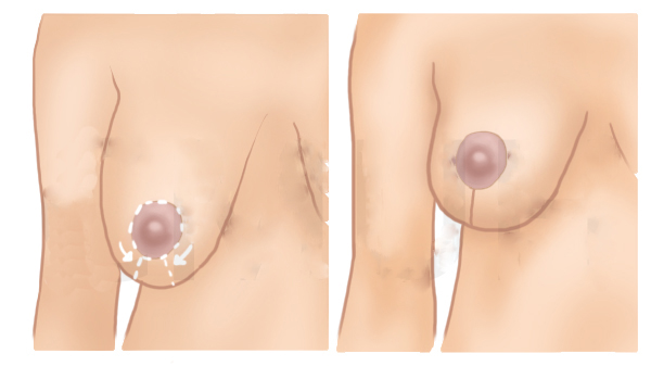 提乳手術1.jpg