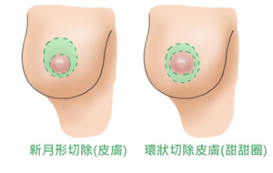 提乳手術2.jpg