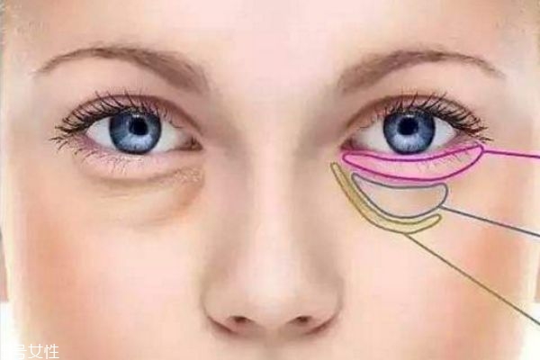 内切眼袋会不会影响视力 内切眼袋后如何消肿
