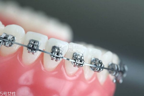 牙齿整形有哪些方法 关于牙齿整形的那些事