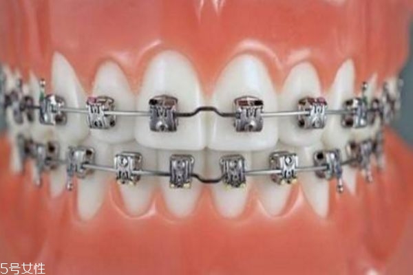 牙齿整形有哪些方法 关于牙齿整形的那些事