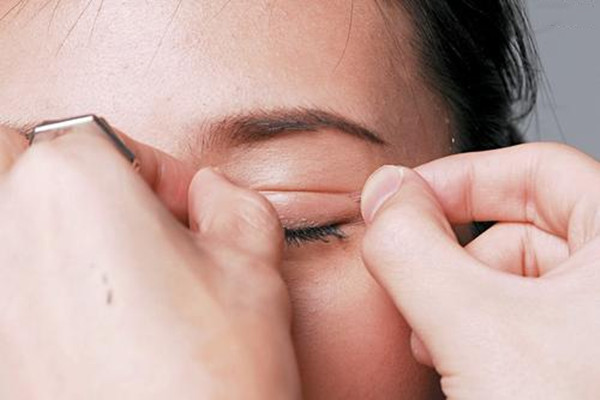 压双眼皮多久能消肿 压双眼皮的恢复过程是怎样的