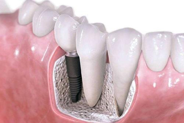 什么情况下适合种植牙齿 种植牙齿分为几个阶段