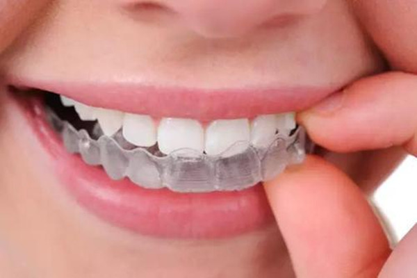 牙洞补牙要戴牙套吗 什么样的牙洞补牙不用戴牙套