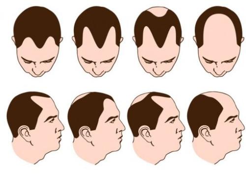 自体毛发移植手术优势 自体毛发移植可以做哪些部位