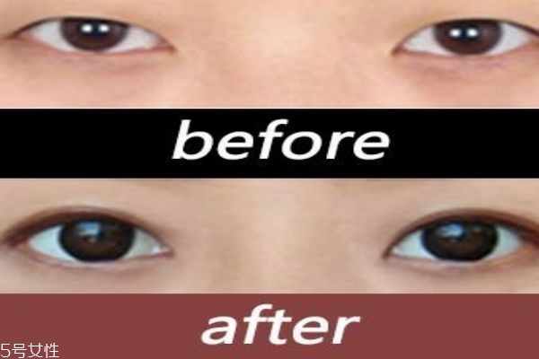 韩式三点双眼皮的缺点 韩式三点双眼皮的优势