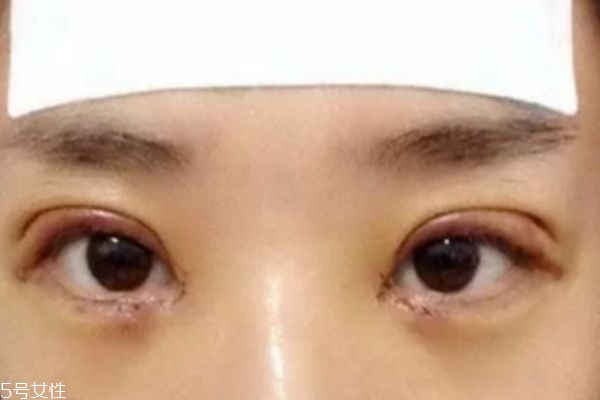 全切双眼皮多久可以化妆 双眼皮手术后注意事项
