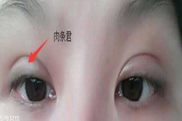 全切双眼皮肉条和肿的区别 有肉条的原因