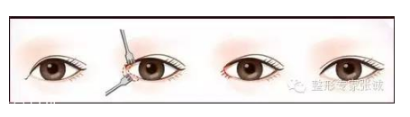 开眼角留疤怎么办 开眼角疤痕增生预防