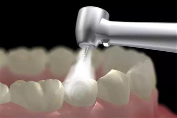 洗牙是否会伤害牙釉质 洗牙是什么原理