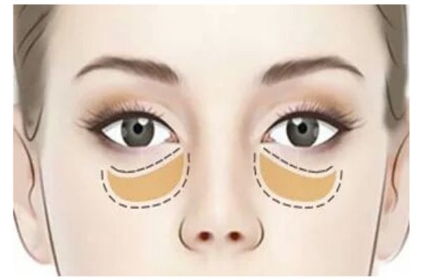怎么可以消除眼袋呢 眼袋可以怎么预防呢