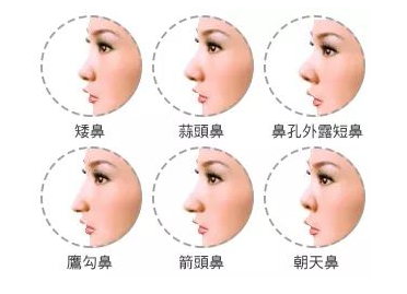 鼻子整形有几种方法 鼻子整形哪种方法最好