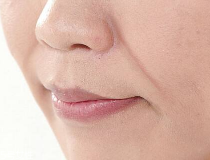 鼻唇沟填充用什么方法 鼻唇沟填充显年轻吗