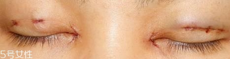 怎么缩短开眼角疤痕消失时间？双眼皮开眼角恢复过程