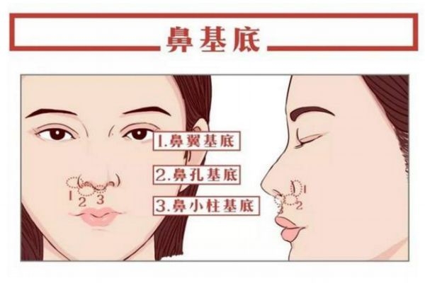 鼻基底填充是什么 关于鼻基底填充