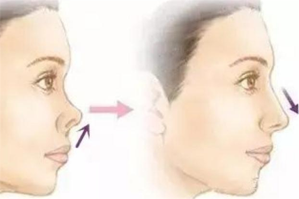 朝天鼻隆鼻效果怎么样 朝天鼻矫正会显得假吗