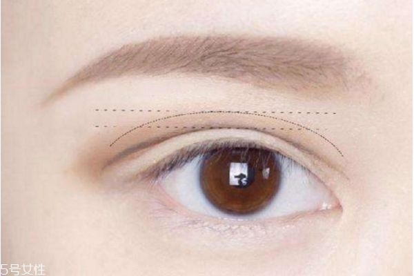 双眼皮手术要了解什么 双眼皮手术前禁忌