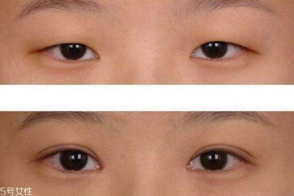 眼睑下垂能治疗吗 眼睑下垂治疗方法