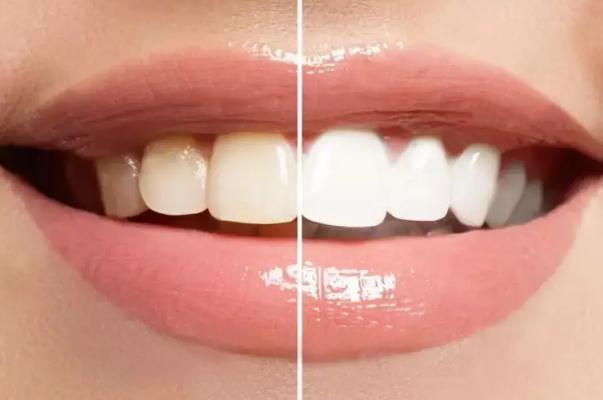 冷光美白牙齿是立马见效吗 冷光美白牙齿是紫外线照射吗