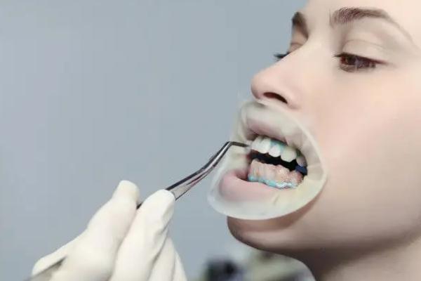 冷光美白牙齿要多少钱一次 冷光美白牙齿对牙齿有什么伤害
