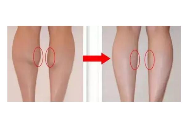 瘦腿针会导致静脉曲张吗 瘦腿针能维持多长时间