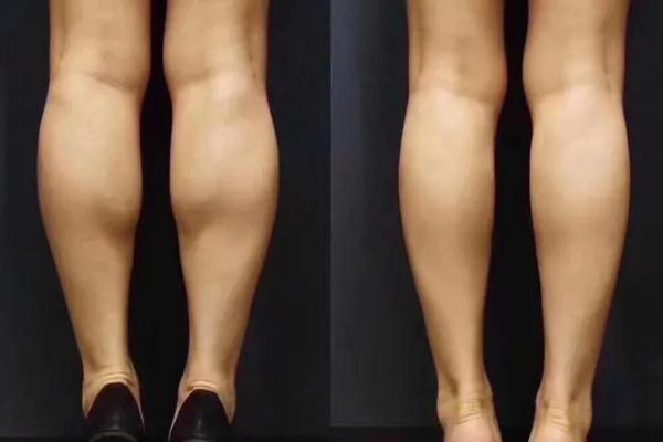 瘦腿针会影响月经吗 瘦腿针会导致瘫痪吗