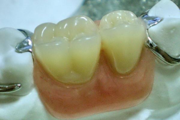 镶牙是怎么固定的 镶牙是固定的好还是活动的好