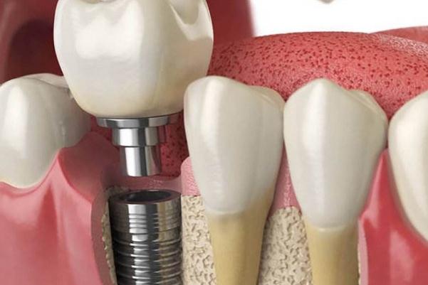 镶牙是怎么固定的 镶牙是固定的好还是活动的好