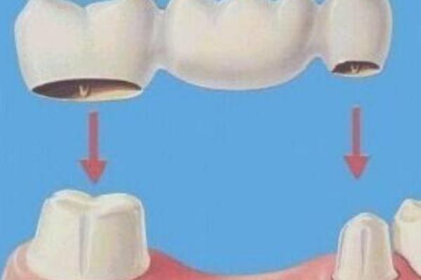 镶牙多少钱一颗牙 镶牙和种牙的区别