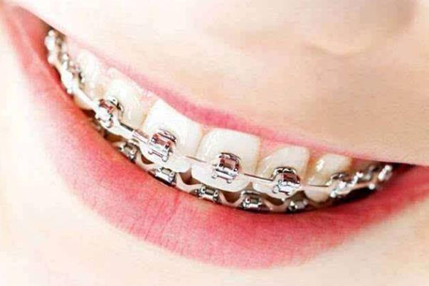 牙套的寿命是多少年 牙套的原理