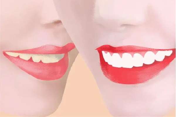 牙齿美白哪种方法好 牙齿美白有几种方式