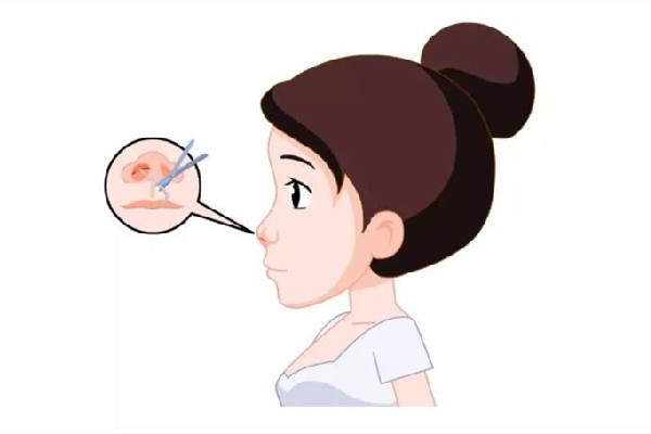 隆鼻后后遗症有哪些呢 隆鼻手术后注意事项