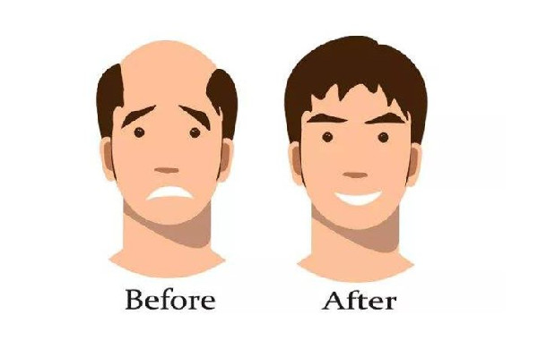 植发后多久可以长出新发 植发后多久可以正常洗头