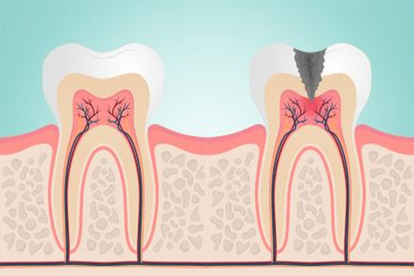 牙齿敏感会导致牙髓炎吗 牙齿敏感的危害