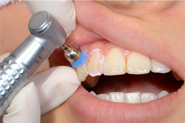 洗牙对牙齿有什么影响 洗牙可以除口臭吗