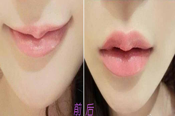丰唇用什么玻尿酸比较好 丰唇有几种方法