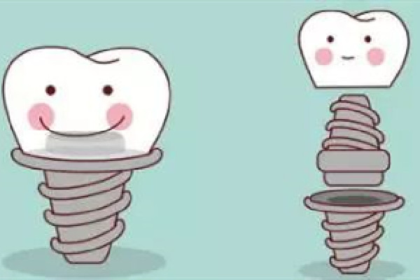 种牙用什么材质的好 种牙有几种材质