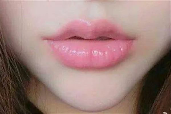 丰唇用什么玻尿酸比较好 丰唇有几种方法