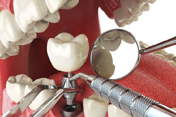 种牙可以用医保吗 种牙的好处与危害