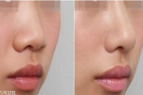 鼻翼缩小手术前后对比照片 缩鼻孔手术对比照片