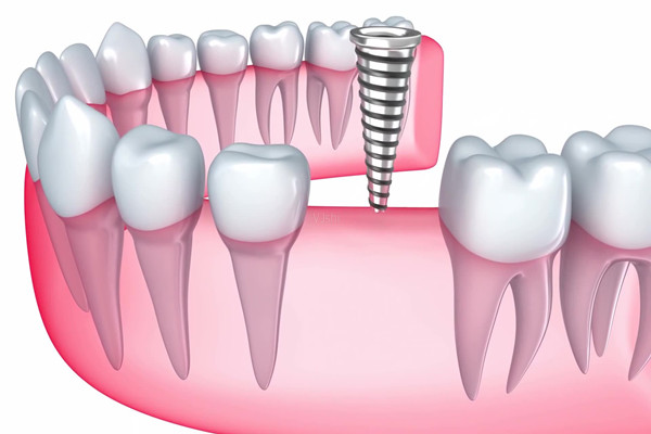 种植牙如何护理 种植牙会有后遗症吗